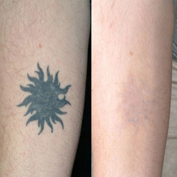 Лазерное удаление татуировок: фото до и после - цены в Спб
